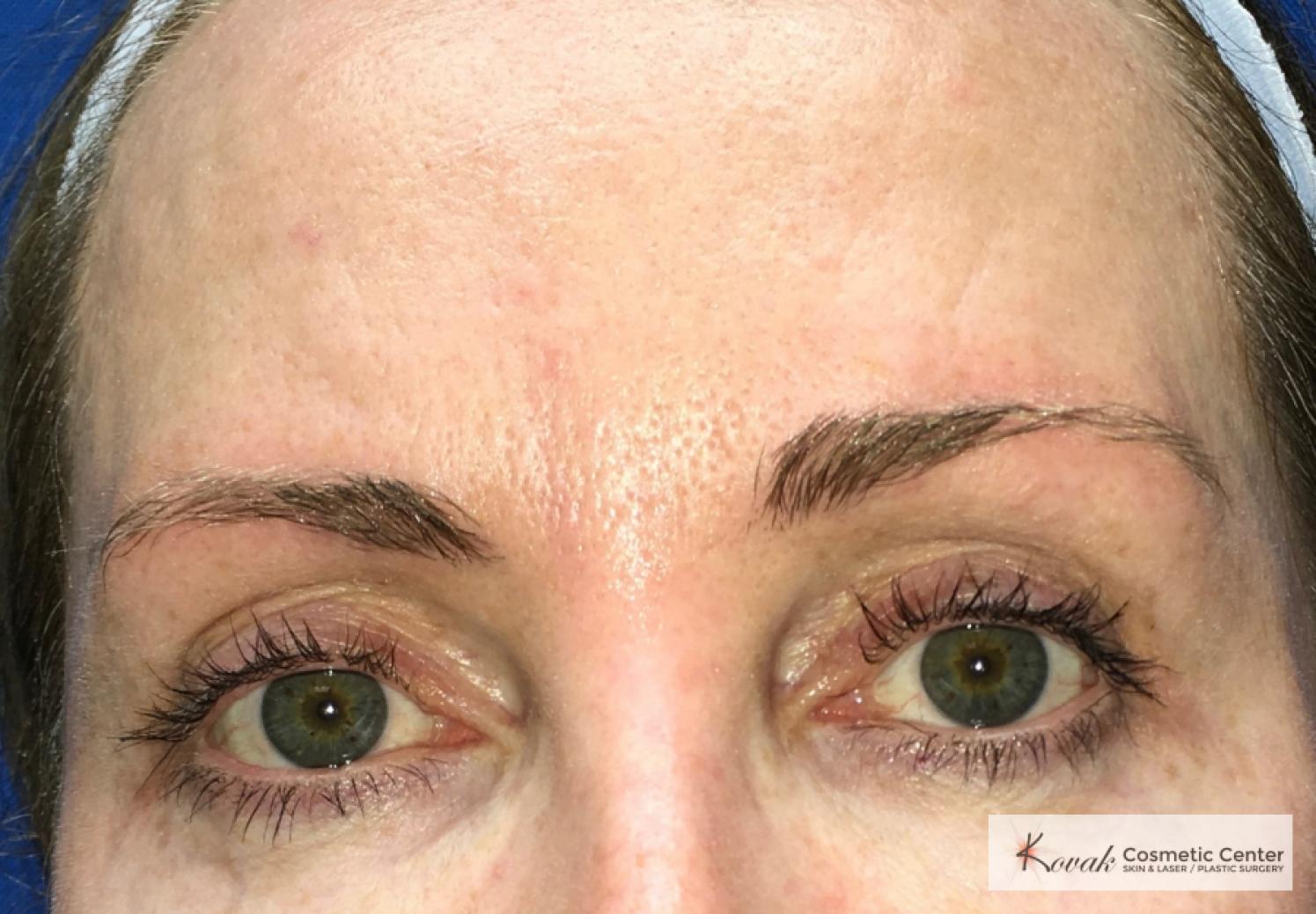 Upper eyelid treatment using Agnes on a 49 year old woman - After  