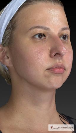 Restylane® Lyft: Patient 1 - Before and After 5