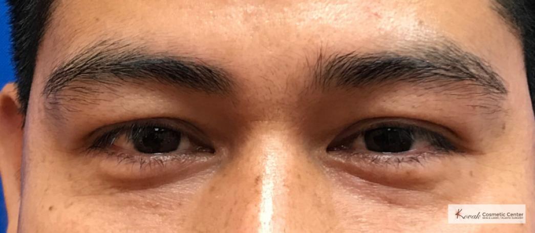 Restylane®: Patient 4 - After  