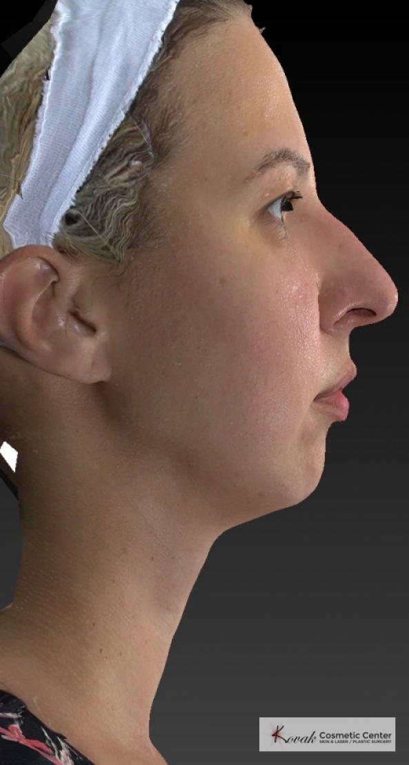 Restylane® Lyft: Patient 1 - Before 