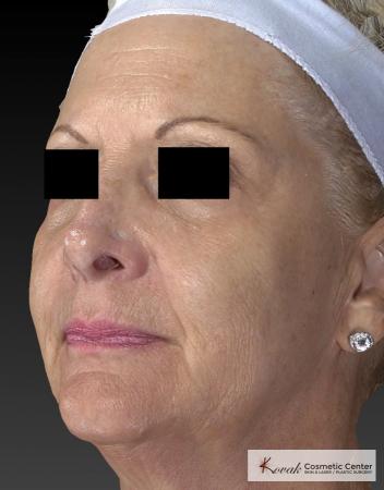Sculptra®: Patient 5 - After 3