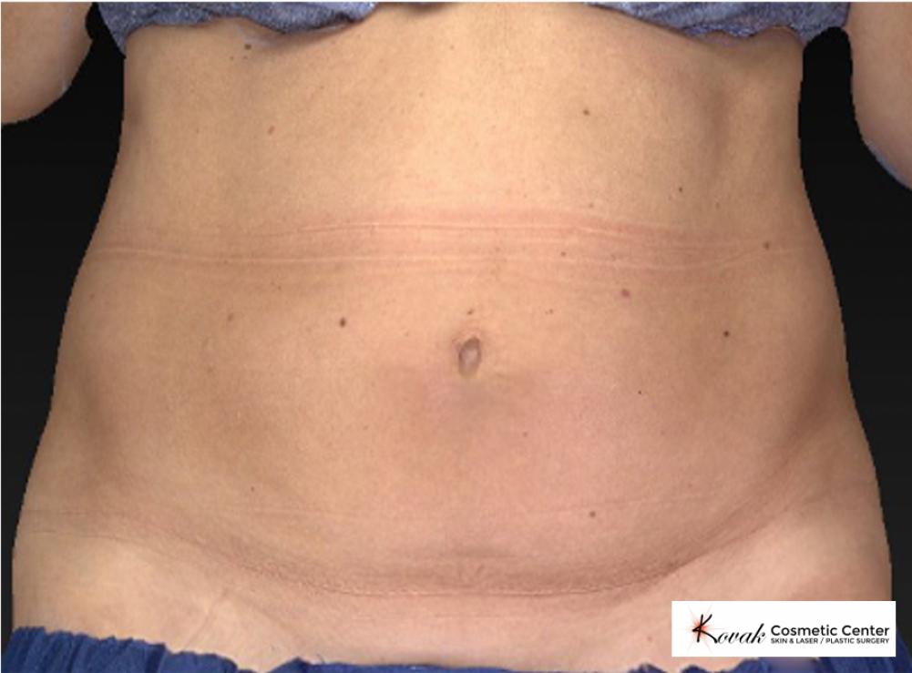 CoolSculpting®: Patient 10 - Before 