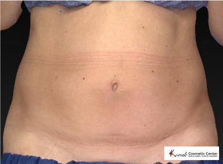 CoolSculpting®: Patient 10 - Before 1