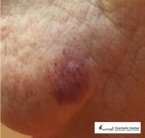 Port Wine Stain: Patient 1 - Before 