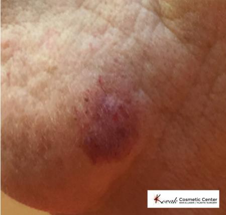 Port Wine Stain: Patient 1 - Before 1
