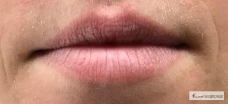Lip Augmentation: Patient 2 - Before and After Image 3