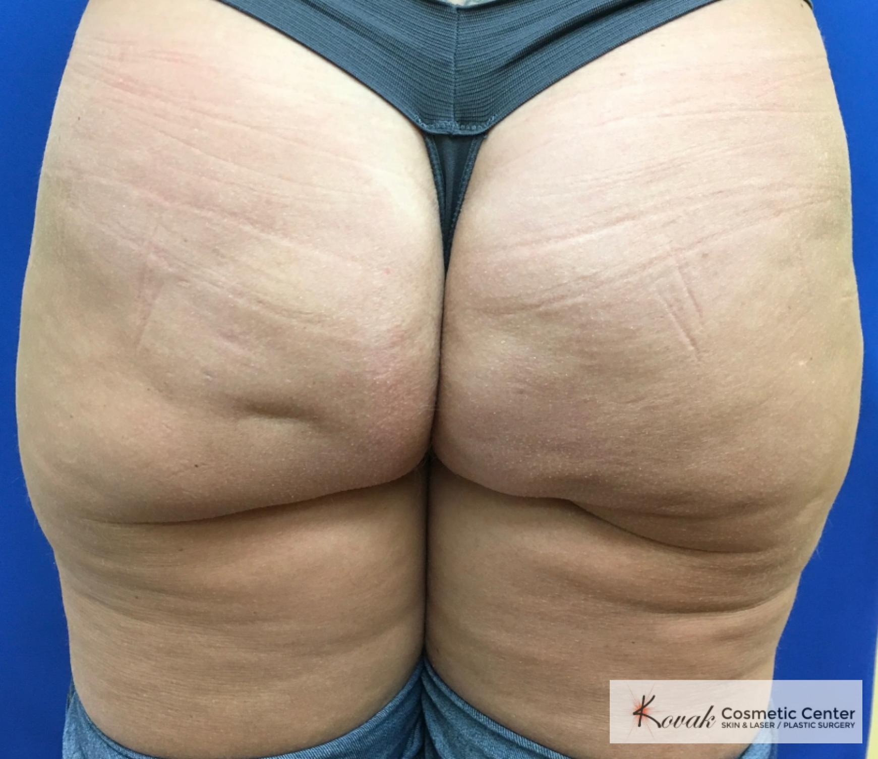 Cellulite Reduction: Patient 4 - After  