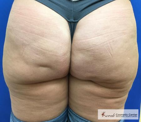 Cellulite Reduction: Patient 4 - After 1
