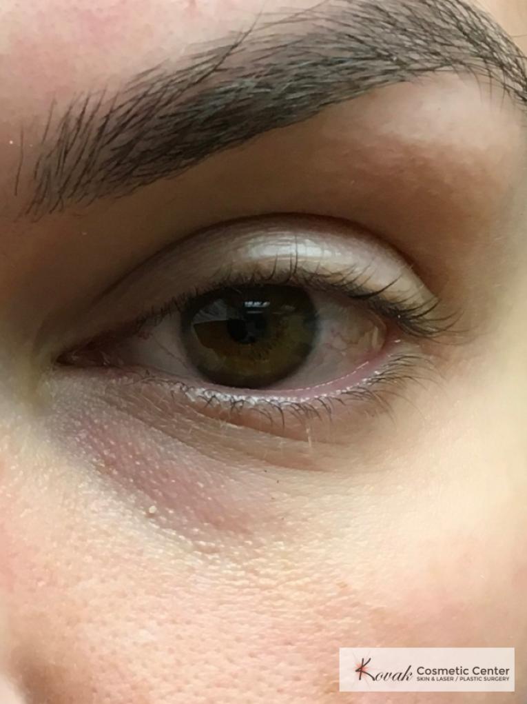 Dark Circle Treatment using Volbella on a 30 year old female - Before and After 2