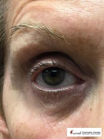 Modified Botox Brow Raise on a 64 year old Woman - After 2
