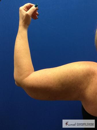 Laser Liposuction of the arms on a 42 year old woman - Before and After 2