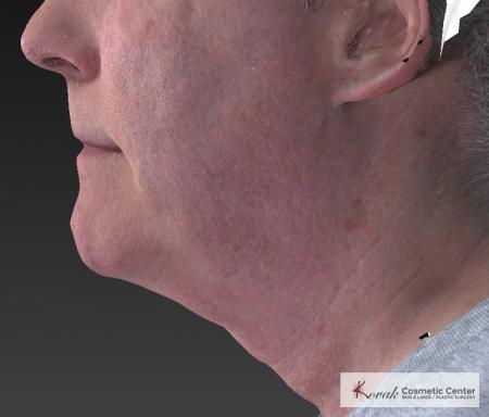 Kybella: Patient 4 - Before Image 2