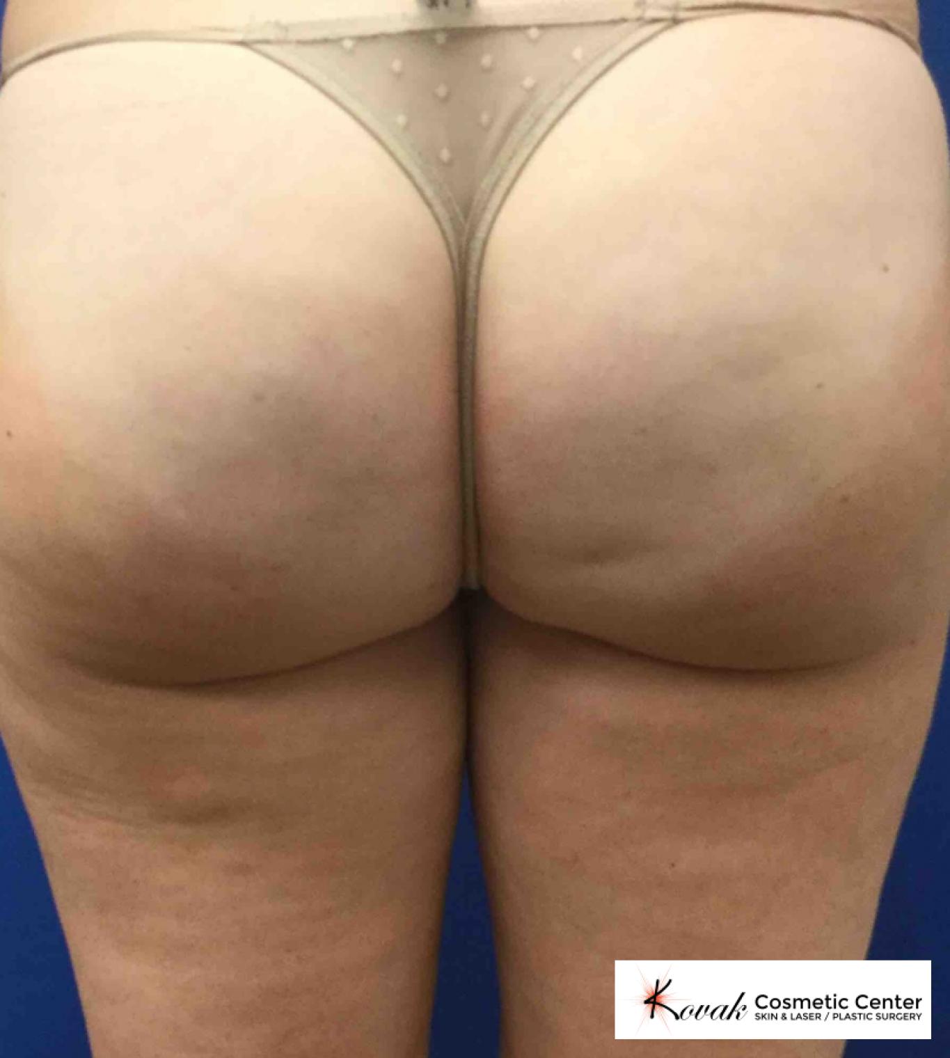 Cellulite Reduction: Patient 3 - After  