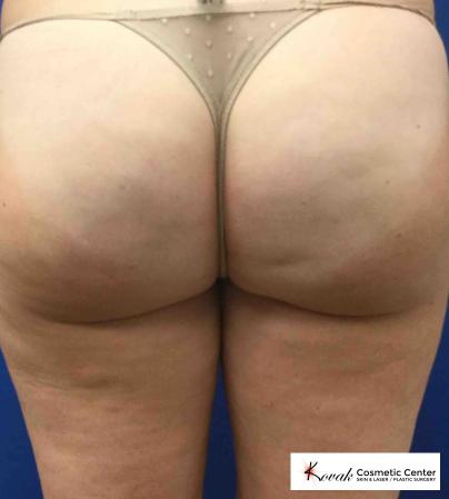 Cellulite Reduction: Patient 3 - After Image 1