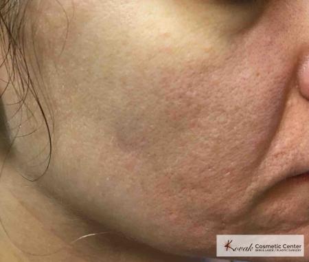 Acne Scars treated with Venus Viva on 35 year old woman - After Image 2