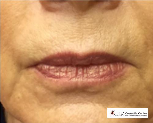 Restylane® Silk: Patient 8 - Before 