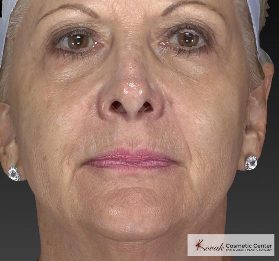 Injectables - Face: Patient 1 - After  