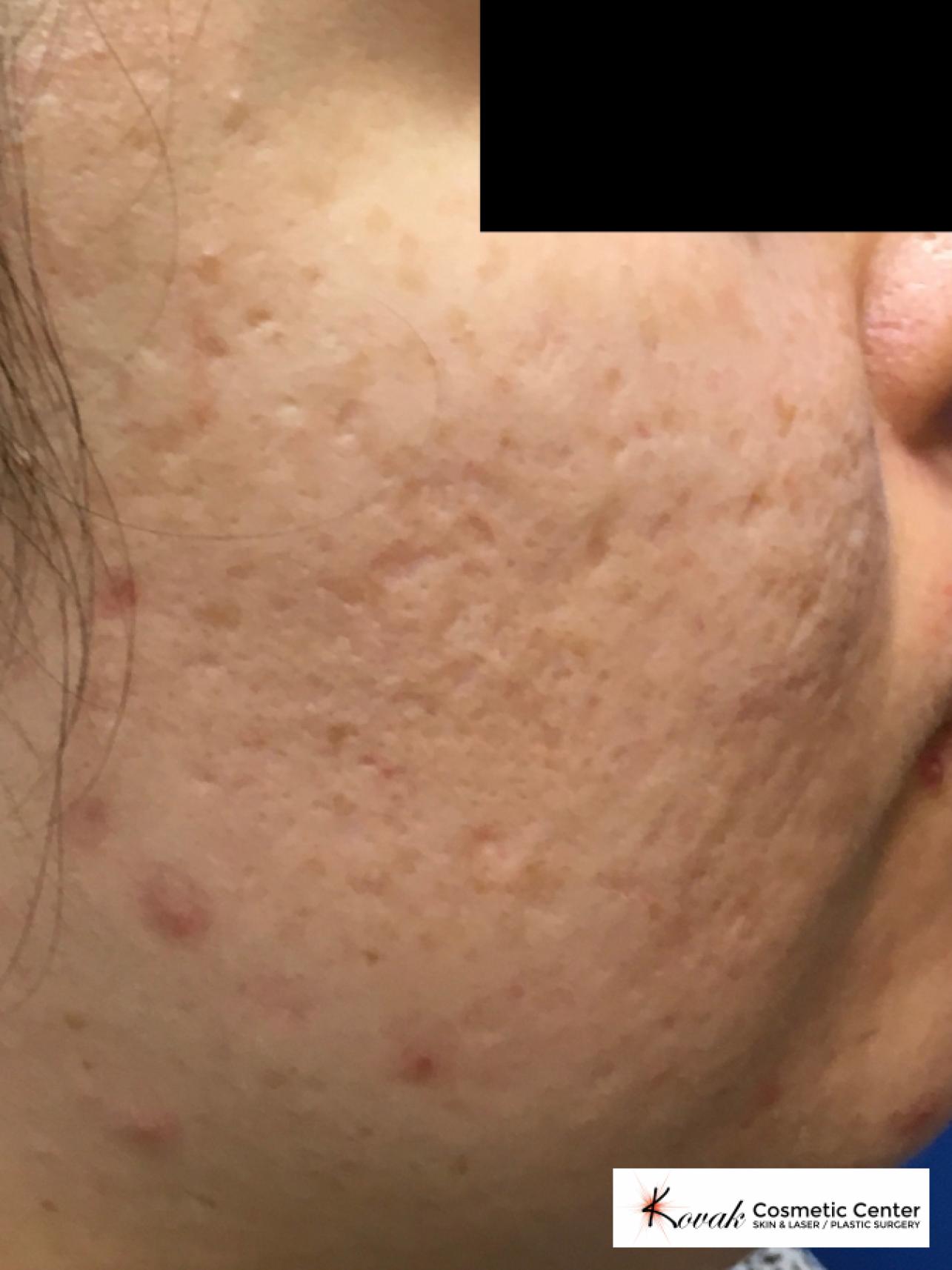Acne Scars treated with Venus Viva on 30 year old female - Before 