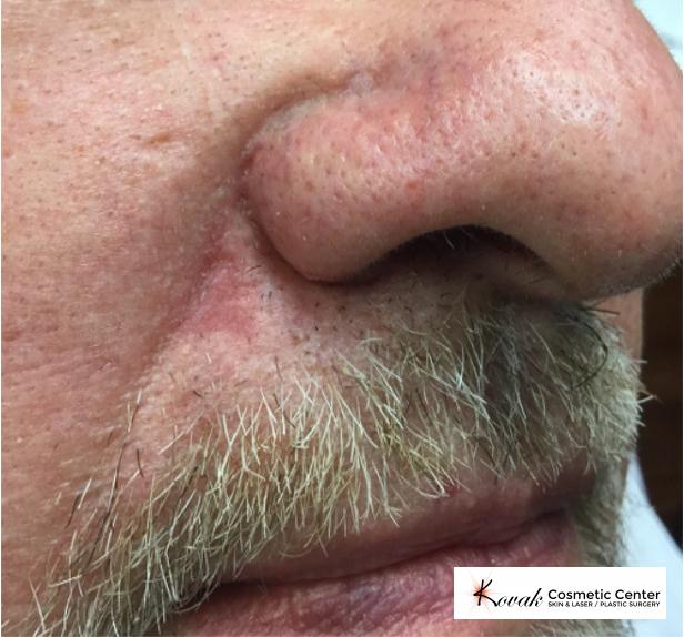 Mole Removal: Patient 2 - After  