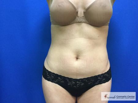 CoolSculpting®: Patient 17 - After 1
