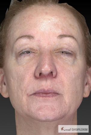 Tyte And Bryte – Face: Patient 6 - After Image 1