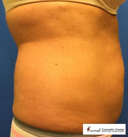 CoolSculpting®: Patient 1 - Before 2