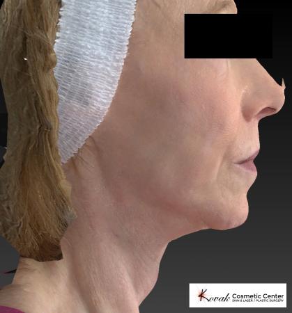 Sculptra®: Patient 1 - After 2