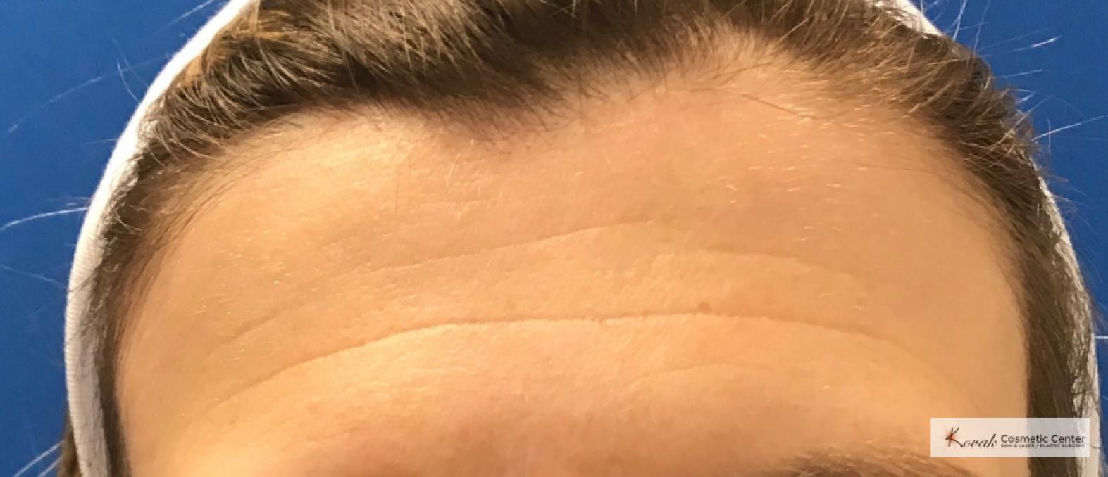 Restylane Silk for Forehead Lines on 43 year old female - Before 