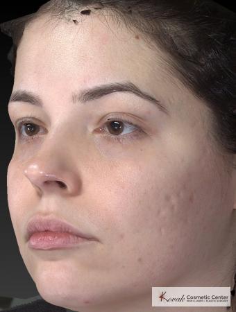 Venus Viva: Patient 4 - Before Image 3