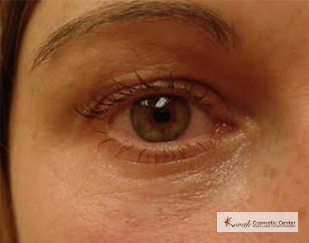 Injectables - Face: Patient 2 - After  