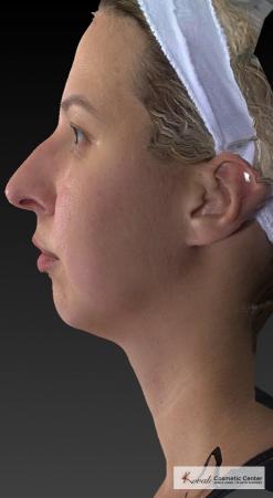 Restylane® Lyft: Patient 1 - Before 2