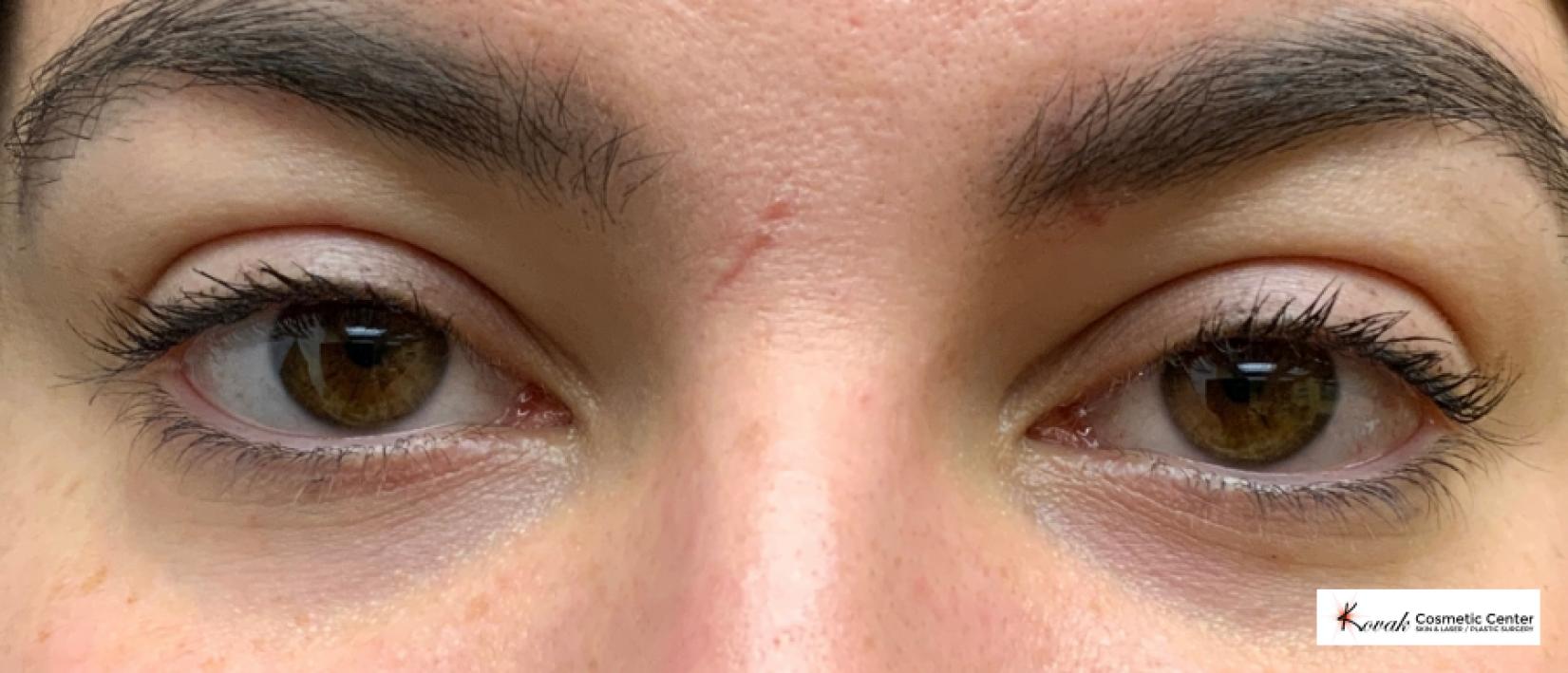 Dark Circle Treatment using Restylane Silk on a 23 year old Female - Before 1