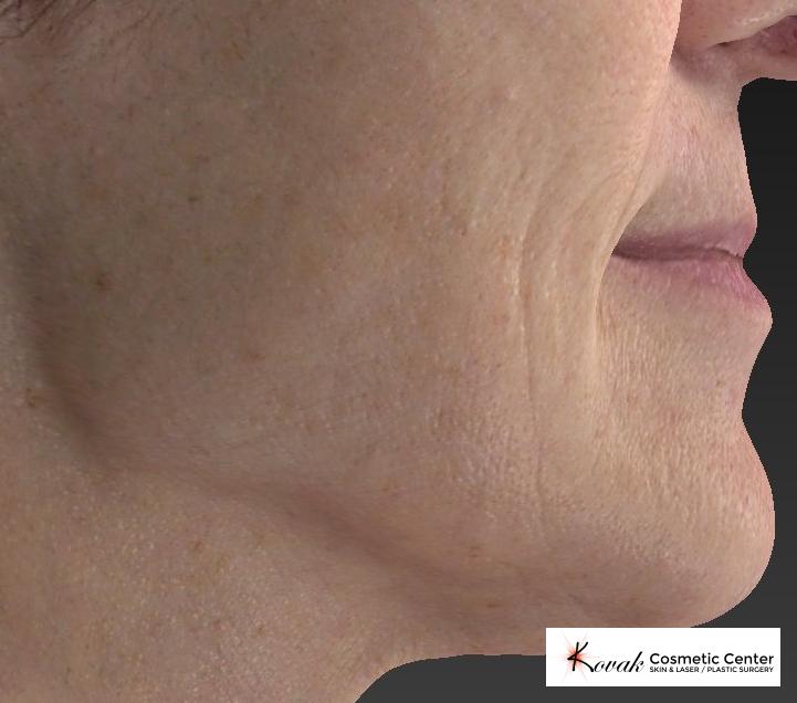 Restylane® Silk: Patient 2 - After 2