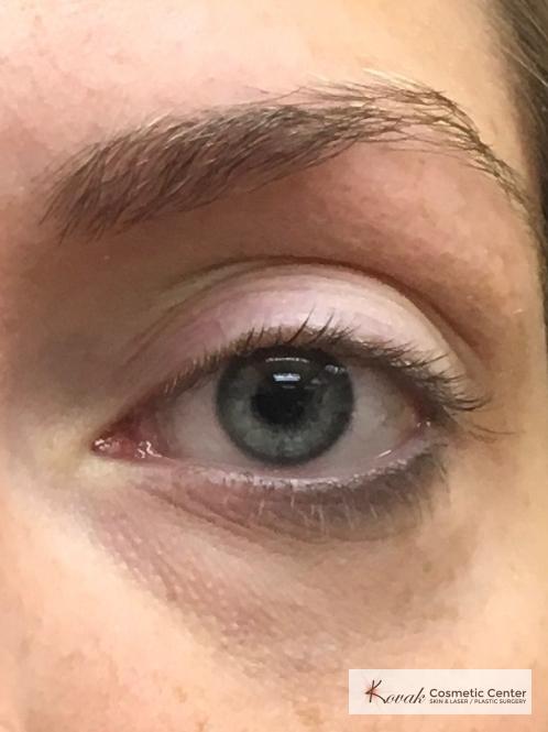 Dark Circle Treatment with Restylane Silk on a 29 year old female - Before and After 2