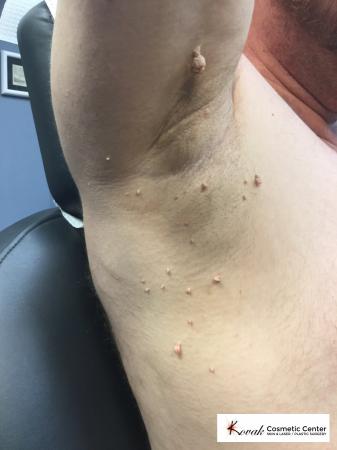 Lumps & Bumps: Patient 1 - Before Image 1