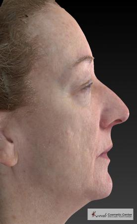 Tyte And Bryte – Face: Patient 6 - After Image 4