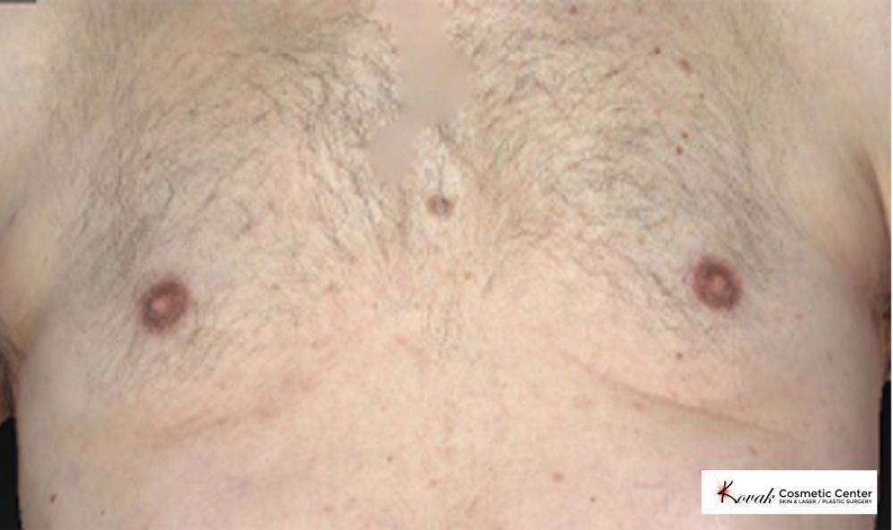 CoolSculpting®: Patient 7 - After  
