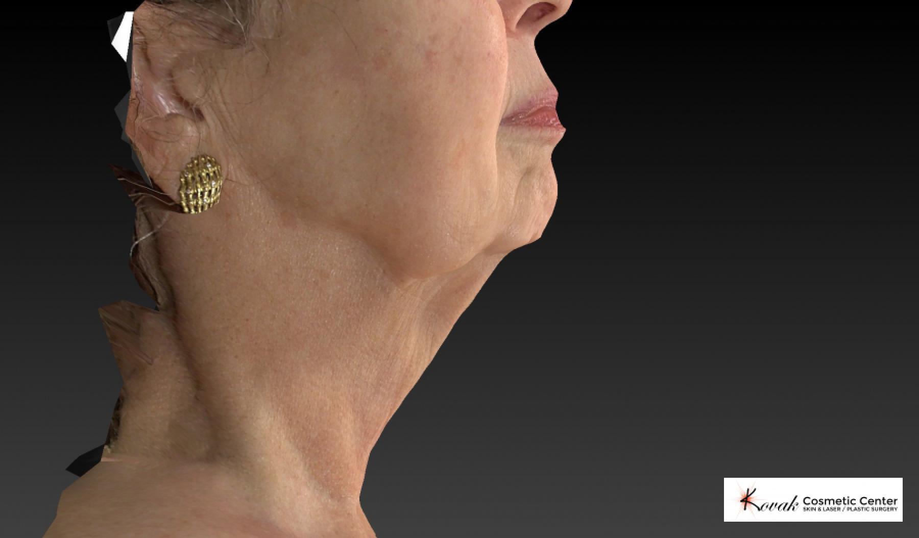 Kybella: Patient 3 - After  