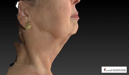 Kybella: Patient 3 - After Image 1