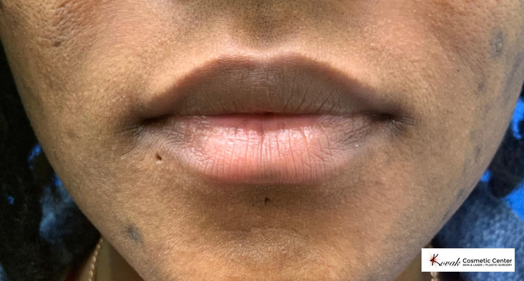 Lip filler using Juvederm on a 31 year old female - Before 