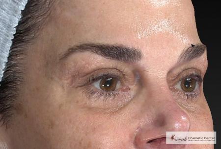 Laser Skin Resurfacing - Face: Patient 2 - After Image 5