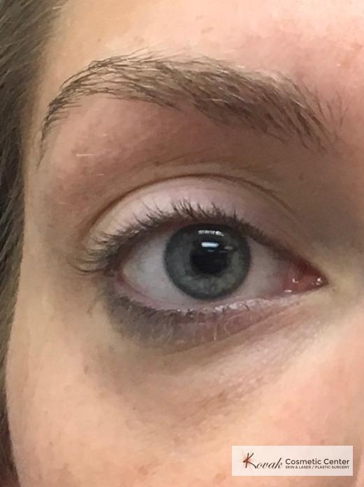 Dark Circle Treatment with Restylane Silk on a 29 year old female - Before 1