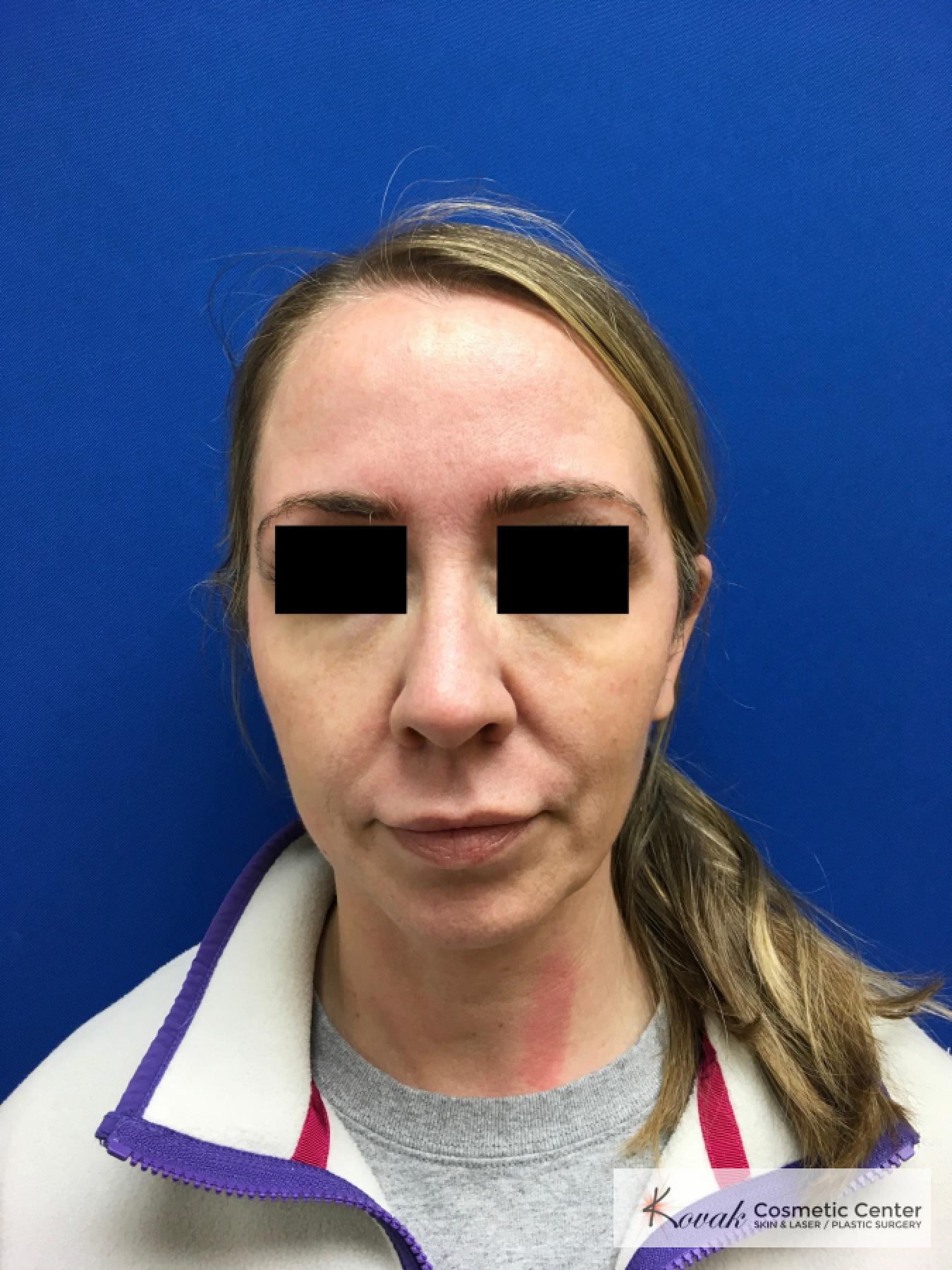 Injectables - Face: Patient 5 - Before 
