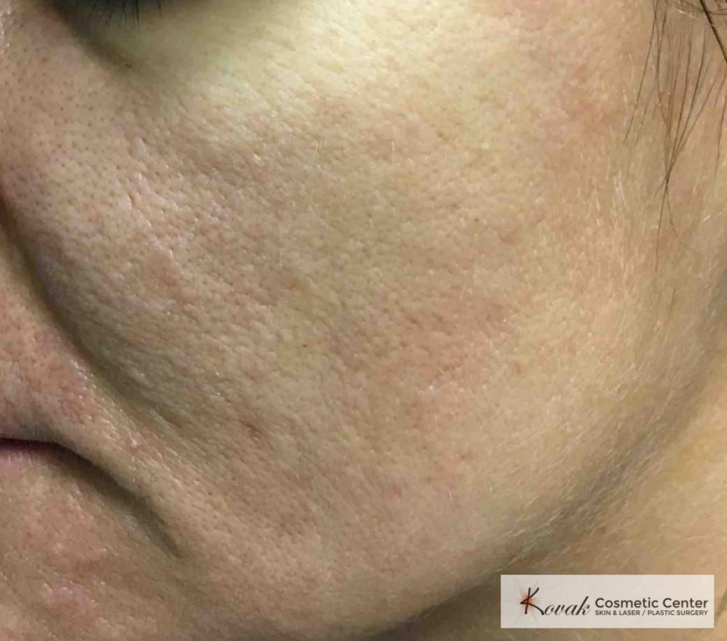 Acne Scars treated with Venus Viva on 35 year old woman - After  