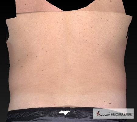 CoolSculpting®: Patient 19 - Before and After 3