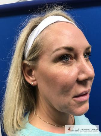 Neck Lift: Patient 3 - Before 1