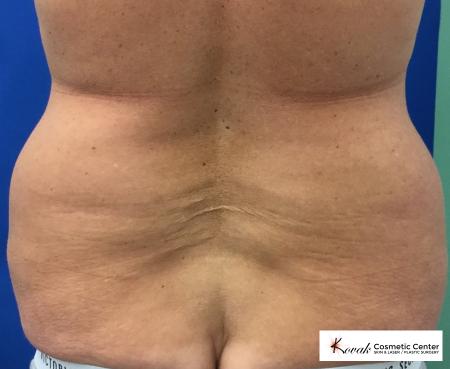 CoolSculpting®: Patient 1 - After 4