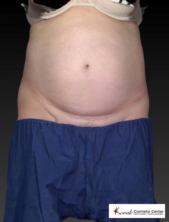 CoolSculpting®: Patient 11 - Before 1