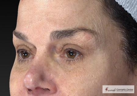 Laser Skin Resurfacing - Face: Patient 2 - Before Image 3