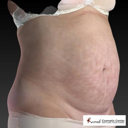 CoolSculpting®: Patient 11 - After 4